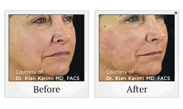 PDO Thread Facelift results for saggy skin at Skinlastiq Medical Laser Cosmetic Spa in Burlingame