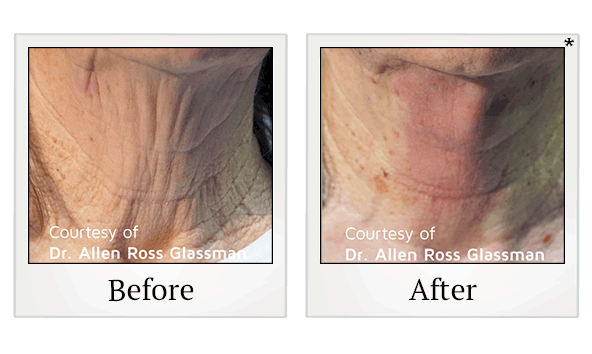 PDO Thread Facelift results for saggy skin at Skinlastiq Medical Laser Cosmetic Spa in Burlingame