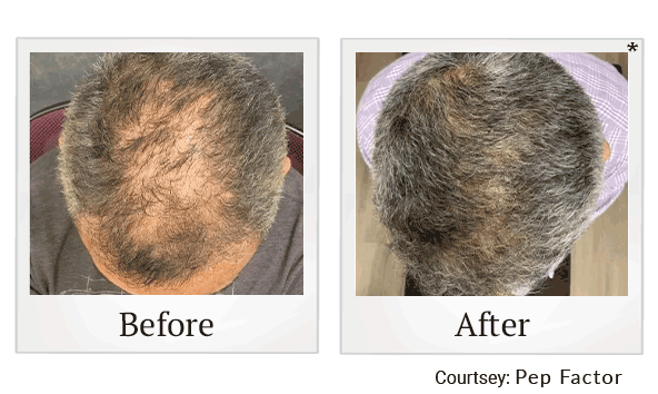 Pep Factor results for hair loss at Skinlastiq Medical Laser Cosmetic Spa in Burlingame