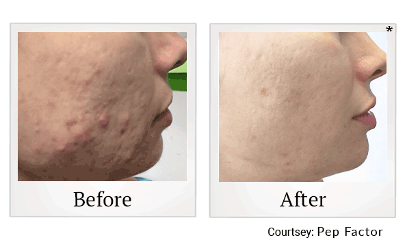 Pep Factor results for acne at Skinlastiq Medical Laser Cosmetic Spa in Burlingame