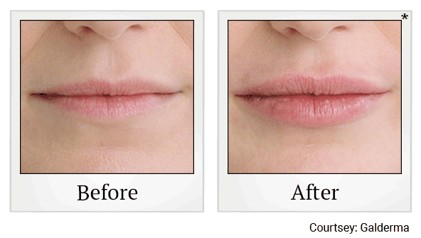 Restylane fillers results for lips at Skinlastiq Medical Laser Cosmetic Spa in Burlingame