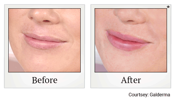 Restylane fillers results for lips at Skinlastiq Medical Laser Cosmetic Spa in Burlingame