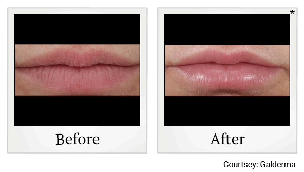 Restylane fillers results for lips at Skinlastiq Medical Laser Cosmetic Spa in Burlingame