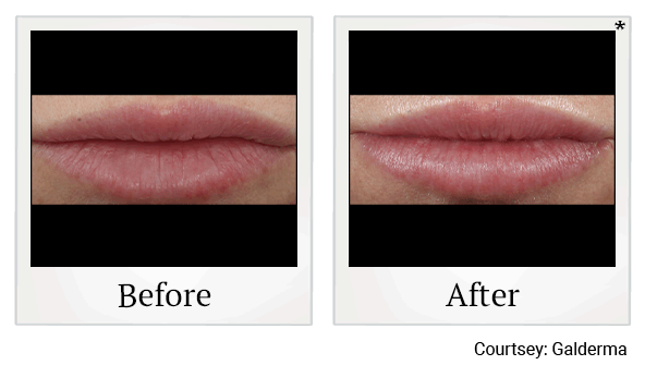 Restylane fillers results for lips at Skinlastiq Medical Laser Cosmetic Spa in Burlingame