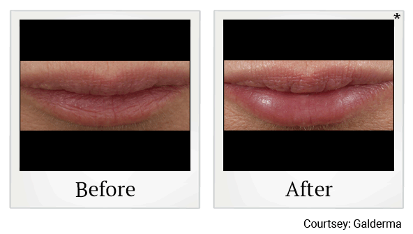 Restylane fillers results for lips at Skinlastiq Medical Laser Cosmetic Spa in Burlingame