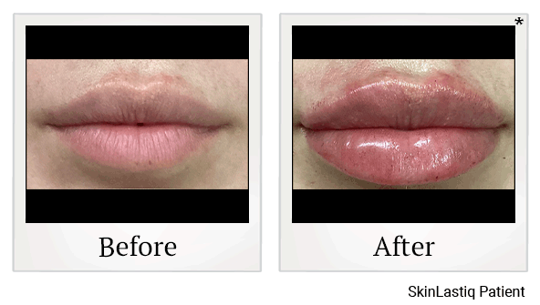 revanesse versa+ before and after at Skinlastiq Medical Laser Cosmetic Spa in Burlingame