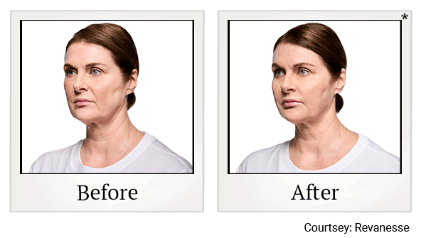 revanesse versa+ before and after at Skinlastiq Medical Laser Cosmetic Spa in Burlingame