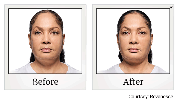 revanesse versa+ before and after at Skinlastiq Medical Laser Cosmetic Spa in Burlingame