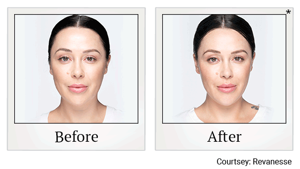 revanesse versa+ before and after at Skinlastiq Medical Laser Cosmetic Spa in Burlingame