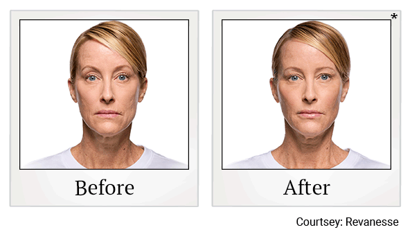 revanesse versa+ before and after at Skinlastiq Medical Laser Cosmetic Spa in Burlingame