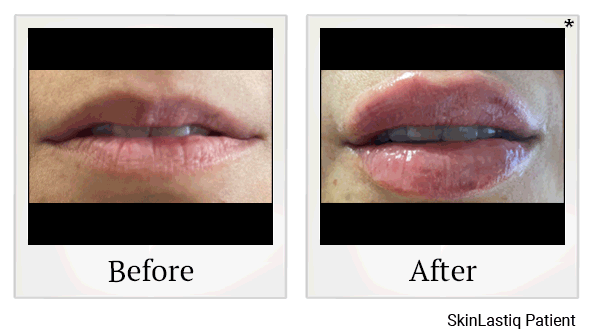 revanesse versa+ before and after at Skinlastiq Medical Laser Cosmetic Spa in Burlingame