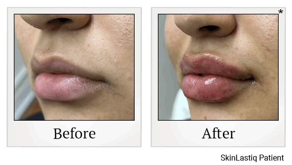 revanesse versa+ before and after at Skinlastiq Medical Laser Cosmetic Spa in Burlingame