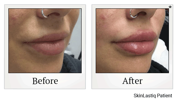 revanesse versa+ before and after at Skinlastiq Medical Laser Cosmetic Spa in Burlingame