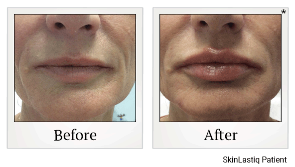 revanesse versa+ before and after at Skinlastiq Medical Laser Cosmetic Spa in Burlingame