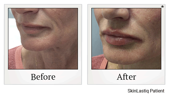 revanesse versa+ before and after at Skinlastiq Medical Laser Cosmetic Spa in Burlingame