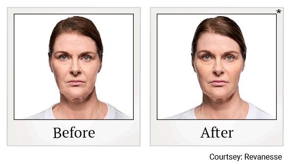 revanesse versa+ before and after at Skinlastiq Medical Laser Cosmetic Spa in Burlingame