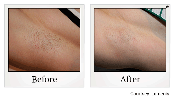 Laser Hair Removal before and after at Skinlastiq Medical Laser Cosmetic Spa in Burlingame