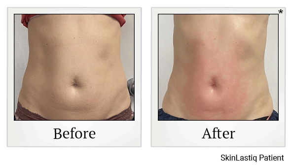 Venus Bliss Body Sculpting results for abdomen at Skinlastiq Medical Laser Cosmetic Spa in Burlingame