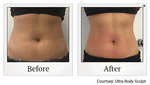 venus bliss before and after at Skinlastiq Medical Laser Cosmetic Spa in Burlingame
