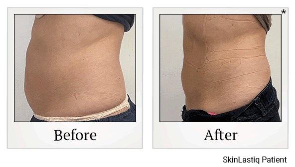 Venus Bliss Body Sculpting results for mid-section at Skinlastiq Medical Laser Cosmetic Spa in Burlingame