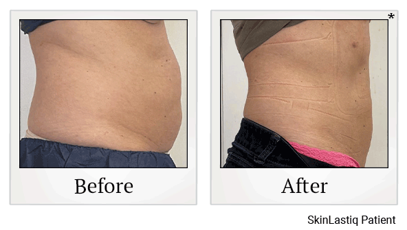 Venus Bliss Body Sculpting results for flanks at Skinlastiq Medical Laser Cosmetic Spa in Burlingame