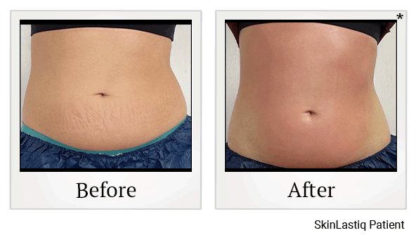 Venus Bliss Body Sculpting results for abdomen at Skinlastiq Medical Laser Cosmetic Spa in Burlingame