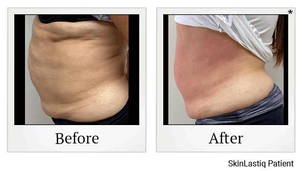 Venus Bliss Body Sculpting results for mid-section at Skinlastiq Medical Laser Cosmetic Spa in Burlingame