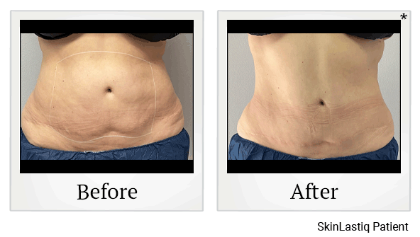 venus bliss before and after at Skinlastiq Medical Laser Cosmetic Spa in Burlingame