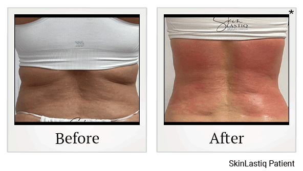 Venus Bliss Body Sculpting results for flanks at Skinlastiq Medical Laser Cosmetic Spa in Burlingame