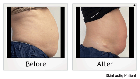 Venus Bliss Body Sculpting results for mid-section at Skinlastiq Medical Laser Cosmetic Spa in Burlingame
