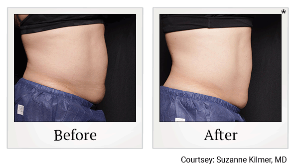 Venus Bliss Body Sculpting results for tummy at Skinlastiq Medical Laser Cosmetic Spa in Burlingame