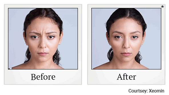 Xeomin results for frown lines at Skinlastiq Medical Laser Cosmetic Spa in Burlingame