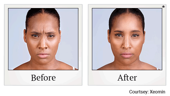 Xeomin results for frown lines at Skinlastiq Medical Laser Cosmetic Spa in Burlingame