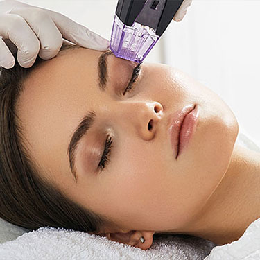 Patient receiving rf microneedling for dark eye circles at Skinlastiq Medical Laser Cosmetic Spa in Burlingame