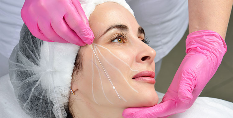Patient receiving PDO Thread Facelift at Skinlastiq Medical Laser Cosmetic Spa in Burlingame